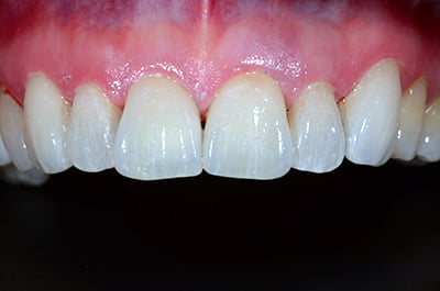Sbiancamento 2/2 - DENTALMED STUDIO DENTISTICO DR. BEGHINI ANGELO CASSANO D'ADDA