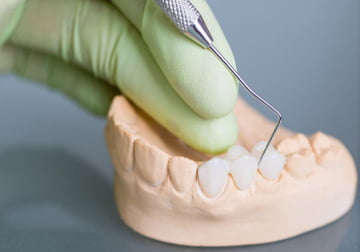 Protesi - DENTALMED STUDIO DENTISTICO DR. BEGHINI ANGELO CASSANO D'ADDA